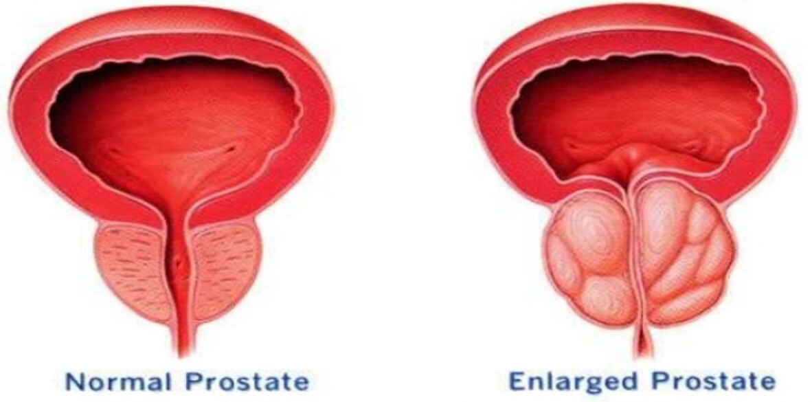 Próstata normal, próstata inflamado